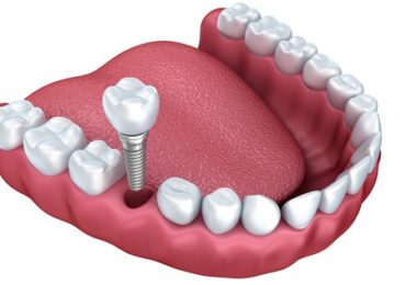 Implant Restoration